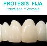 Protesis dentales fijas